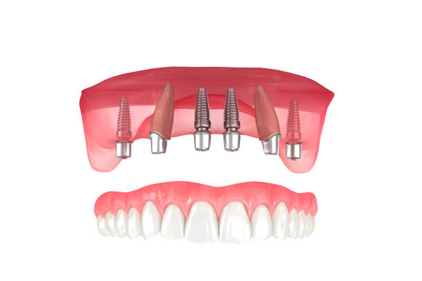all-on-4 implant supported dentures near you