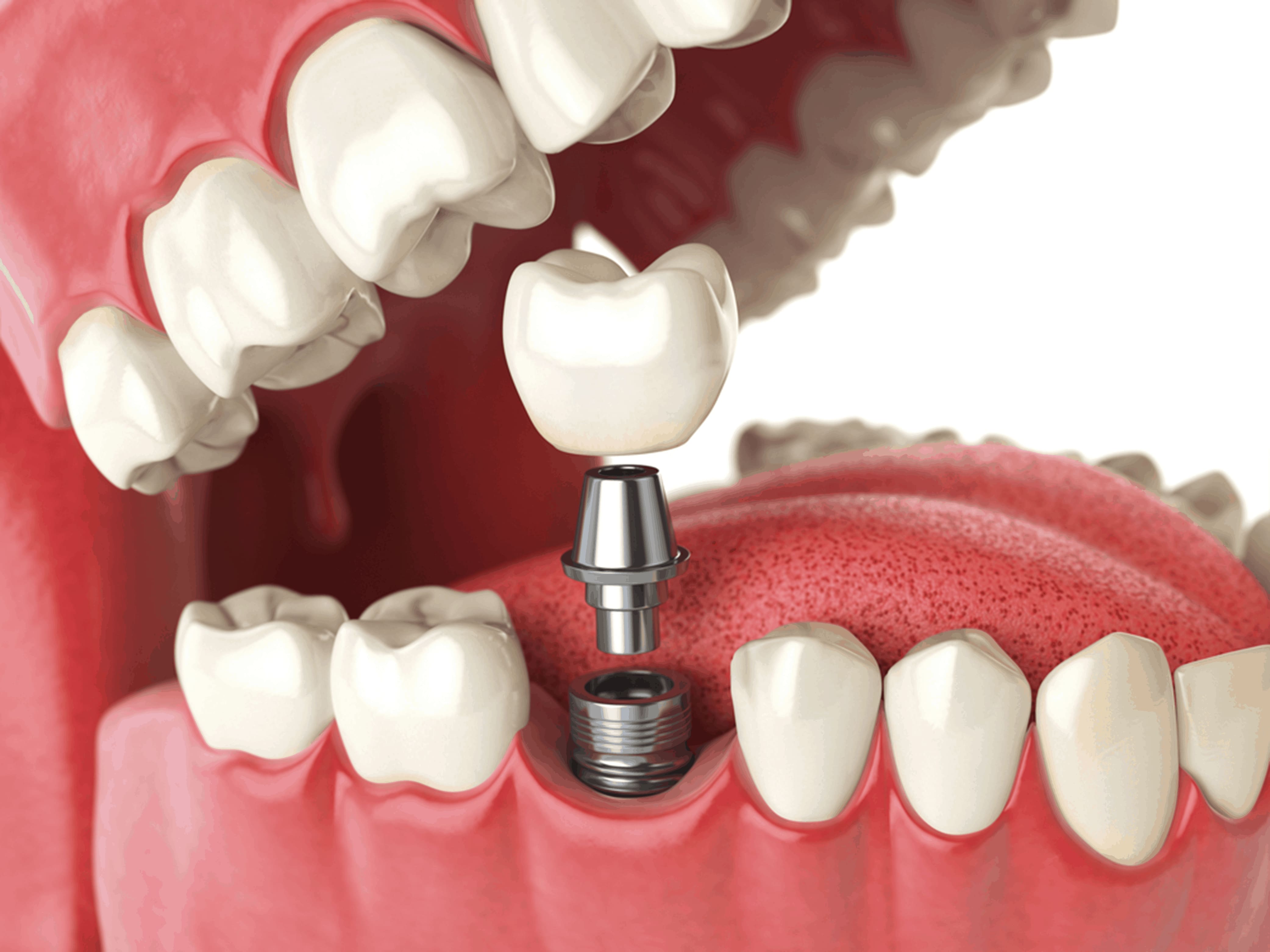 dental implants vs dentures