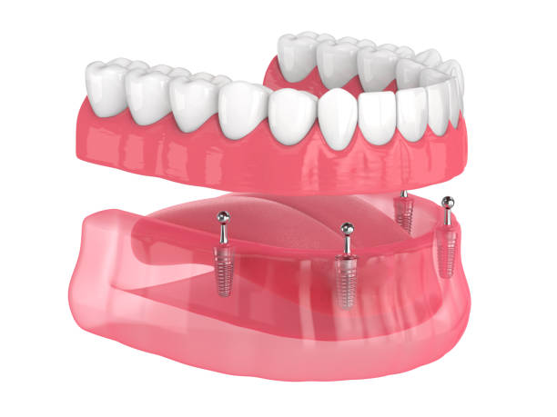 implant supported dentures near you