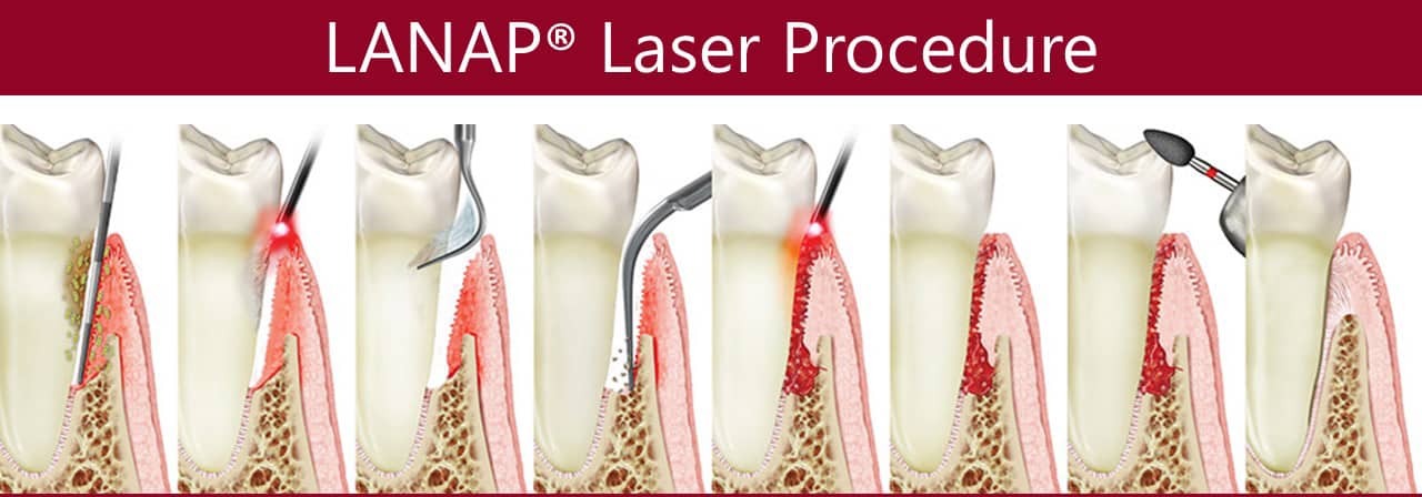 LANAP® procedure in los angeles