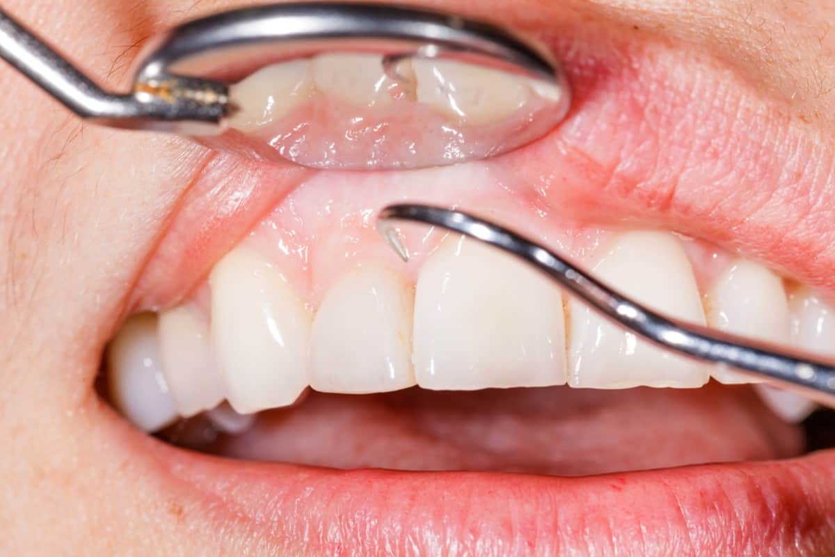 top 5 reasons to go for dental scaling