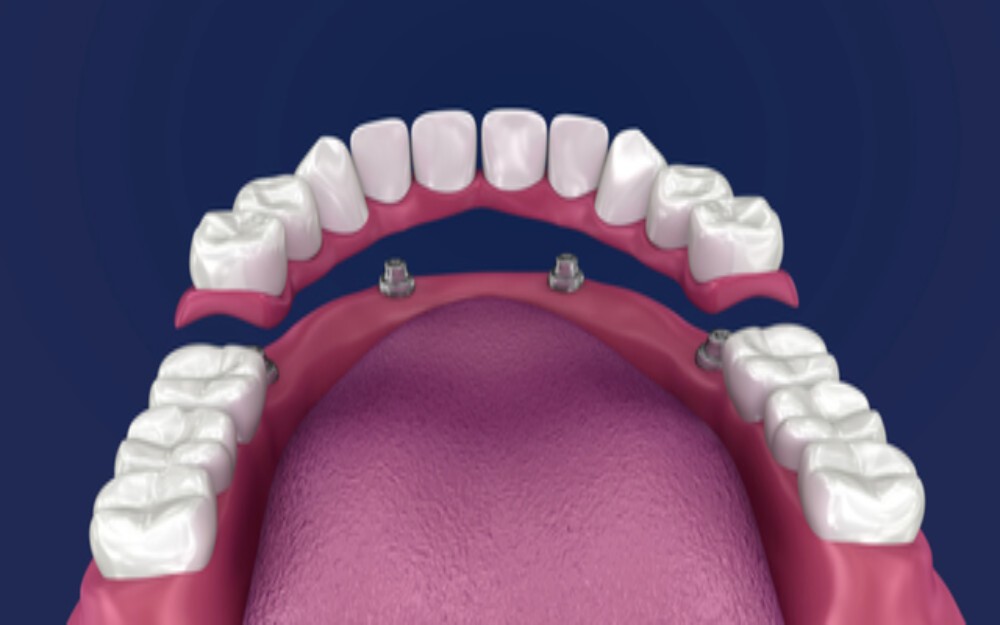 implants or dentures and why you shouldn't choose one or the other