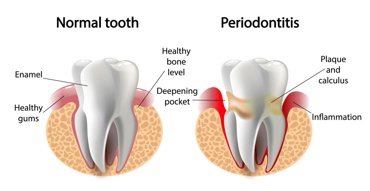 everything you should know about periodontal treatment