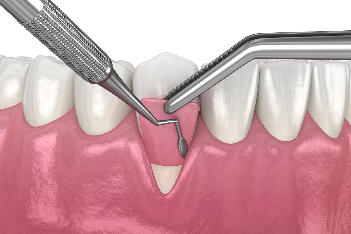 gum recession and gum grafting identifying the perfect candidates