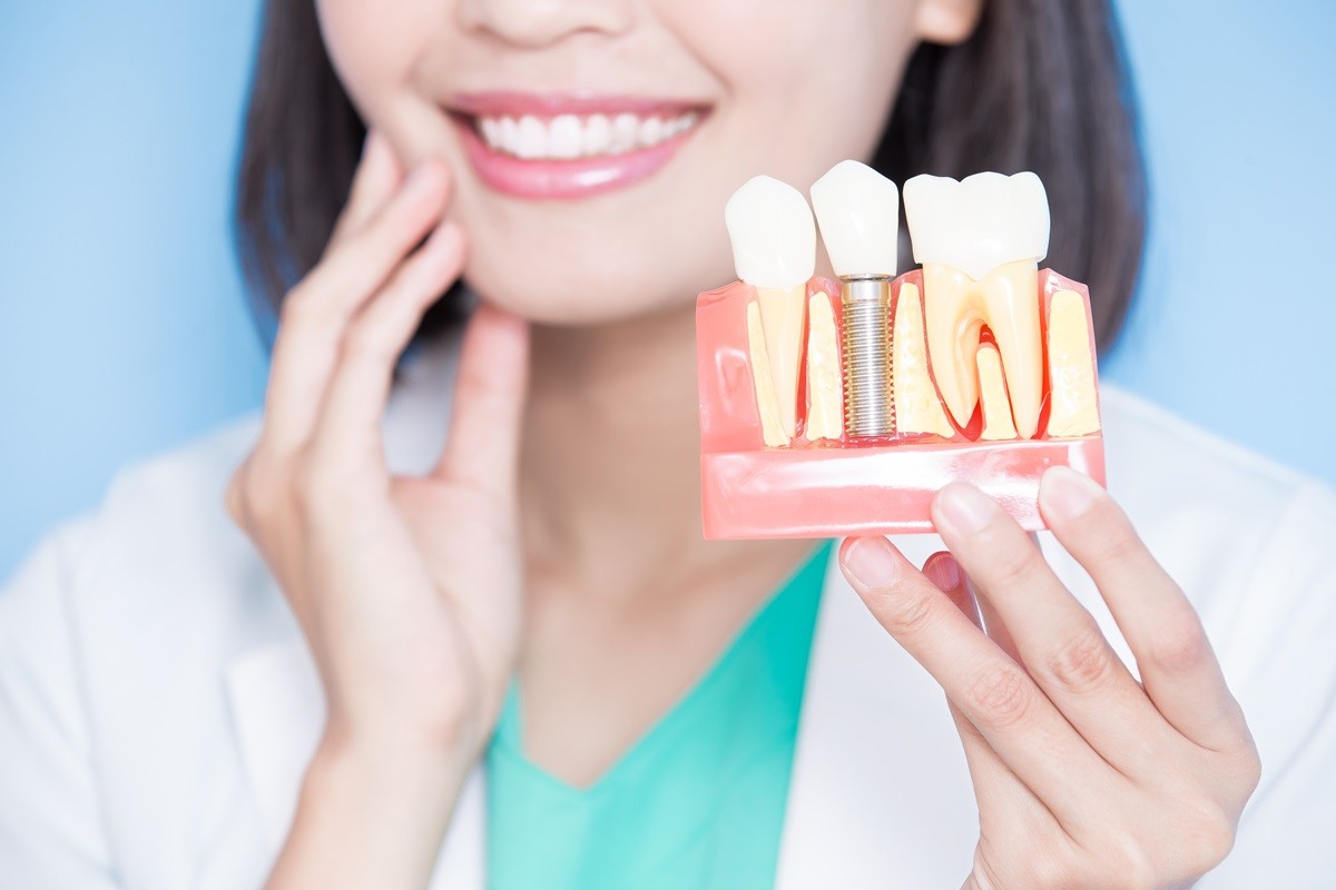 debunking the myths surrounding dental implants