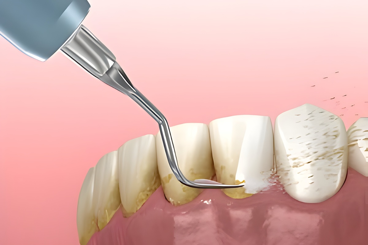 importance of scaling and root planing in periodontal treatment