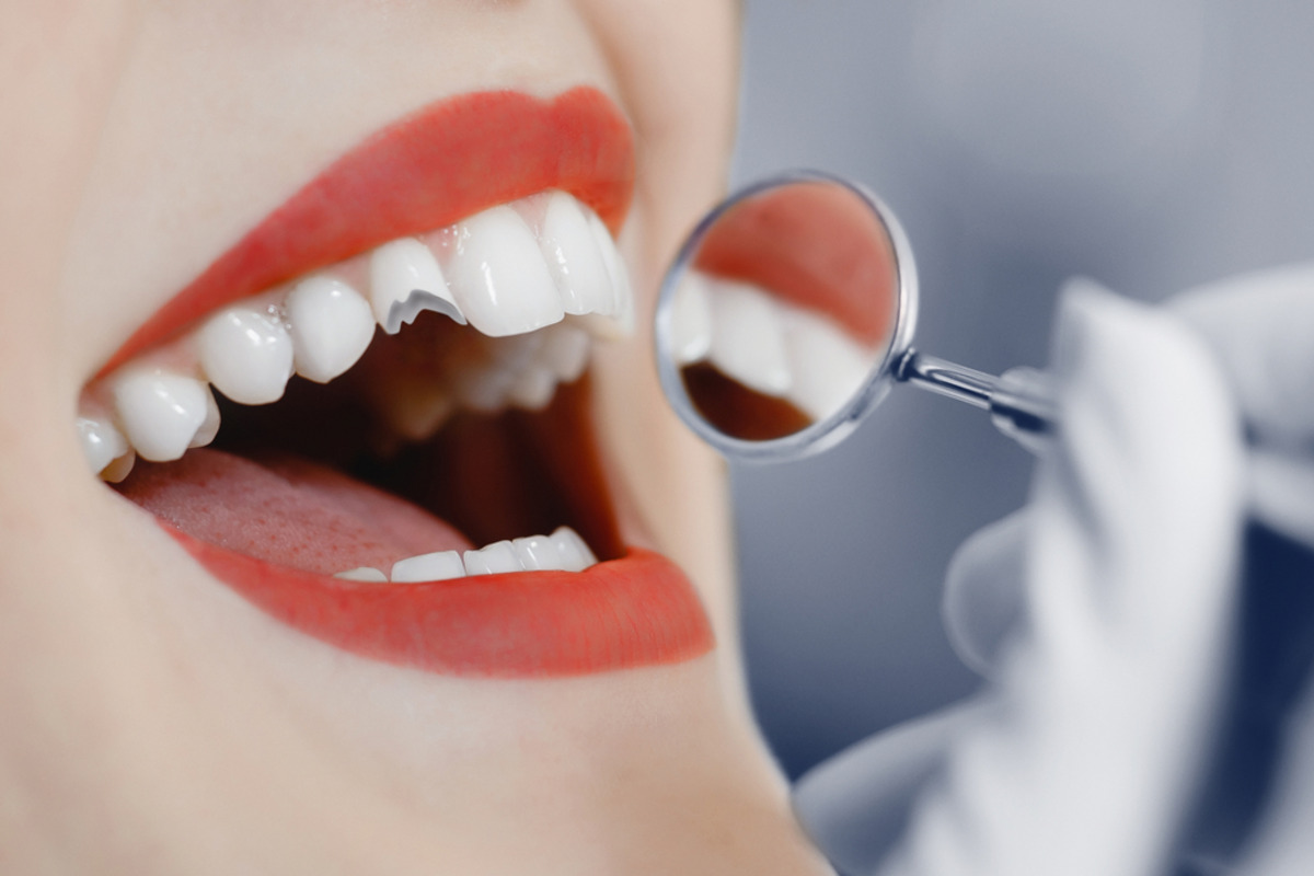 how to fix a chipped tooth